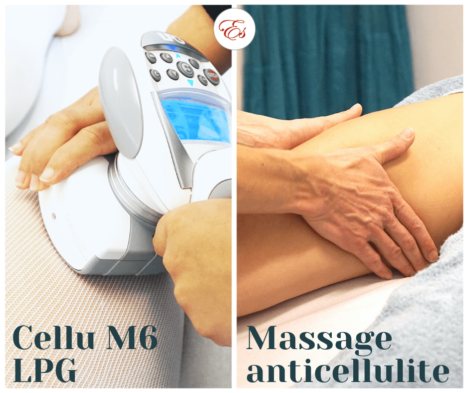 Cellu M6 LPG cure anticellulite vevey efficace